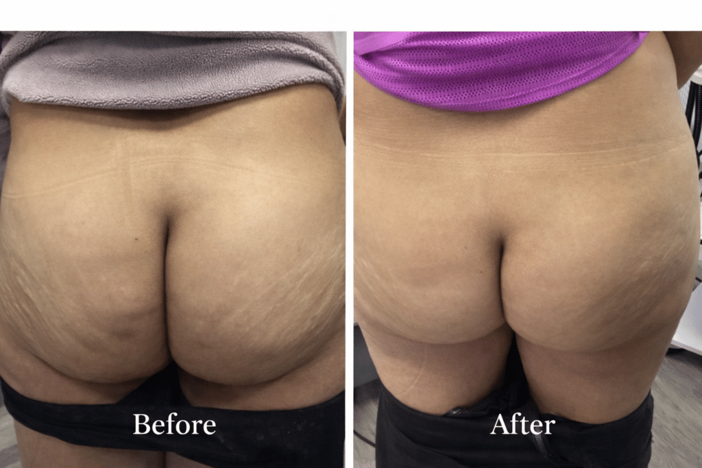 Before and After Image: Emsculpt - right-side