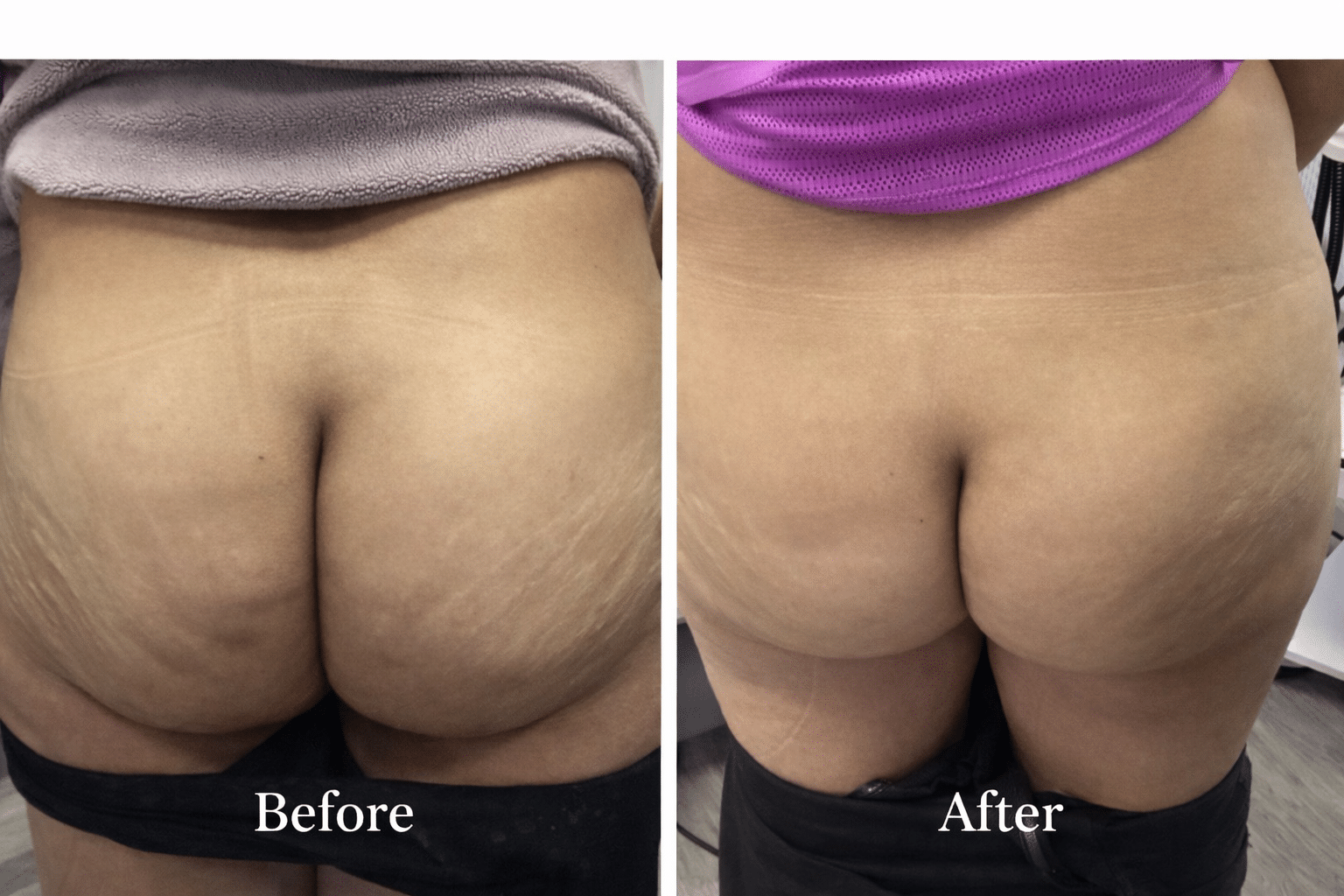 Before and After Image: Emsculpt - right-side