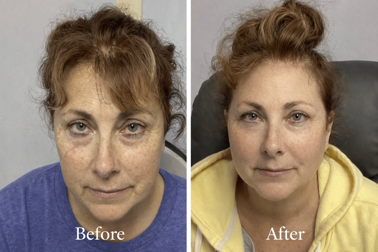 Before and After Image: IPL Facial  - right-side