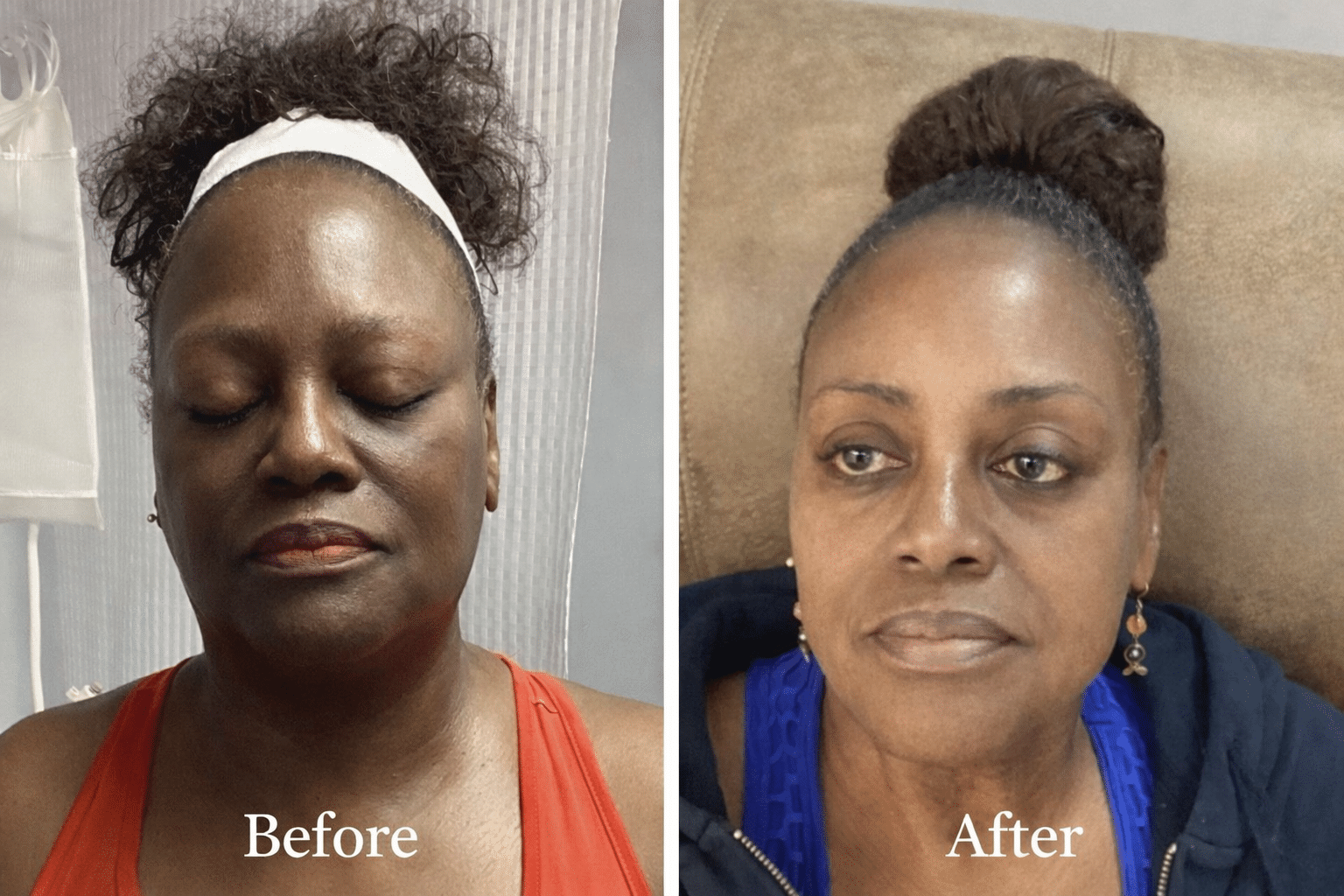 Before and After Image: Platinum Skin Restoration  - right-side