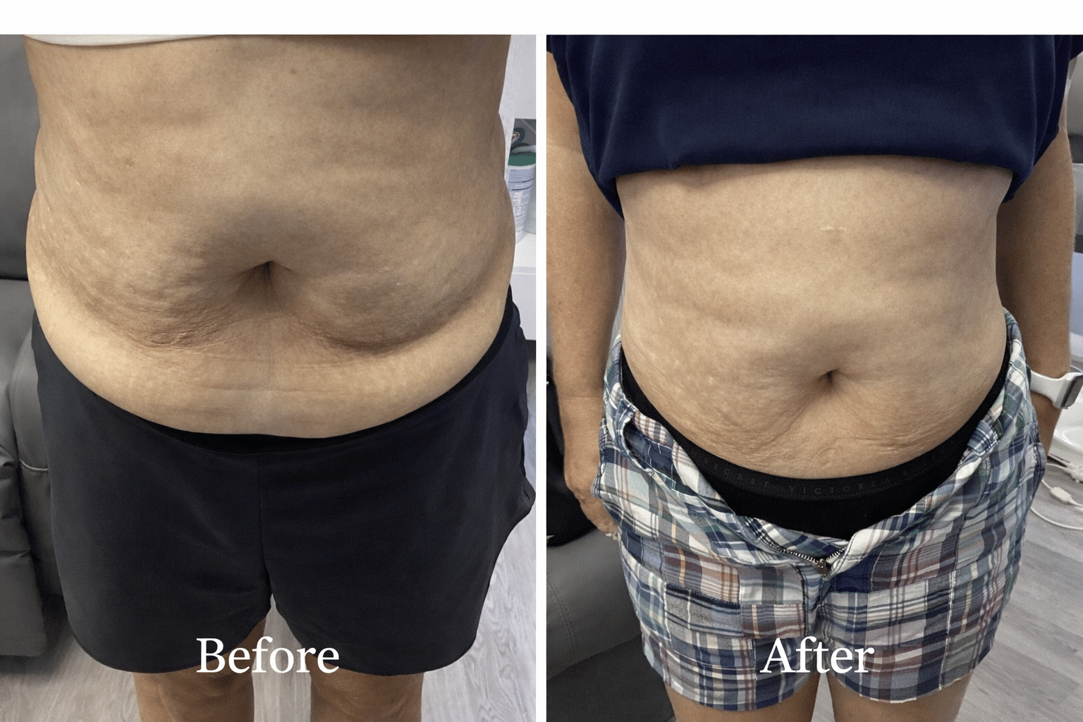 Before and After Image: Weight Loss Transformation - right-side